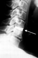 X-ray image of an implanted cervical intervertebral disc made of BAS-0