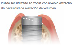 Implante Ideal para indicaciones complejas
